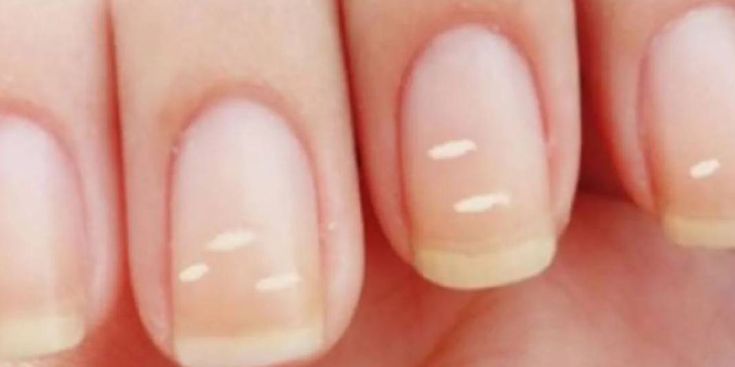 Vitamin eksikliği sandığınız çizgiler ipucu olabilir! Vitamin eksikliği mi, başka bir sorun mu? İşte cevabı… 3